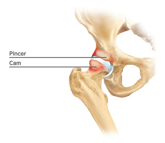 Hip joint - mechanisms of impingement: cam and pincer