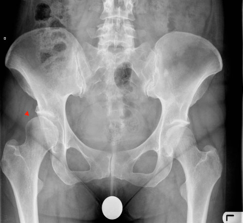 Hip dysplasia and femoral head