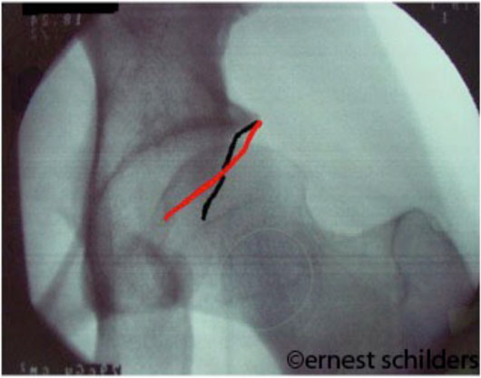 Cross over sign of pincer abnormality