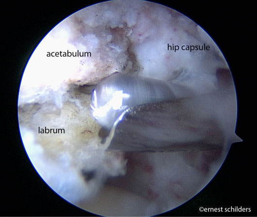 arthroscopic picture showing a labral detachment - trimmed pincer deformity