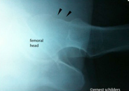arthroscopic picture showing a femoral neck osteoplasty - xray cam resection