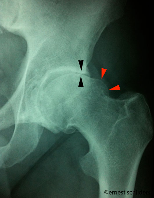 osteoarthritis of the hip - hip x ray